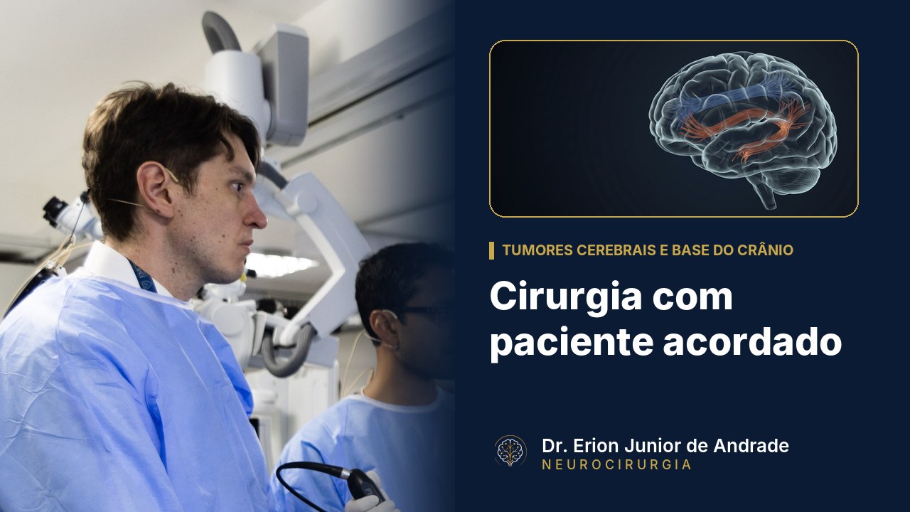 Cirurgia com paciente acordado: quando é indicada no glioma?
